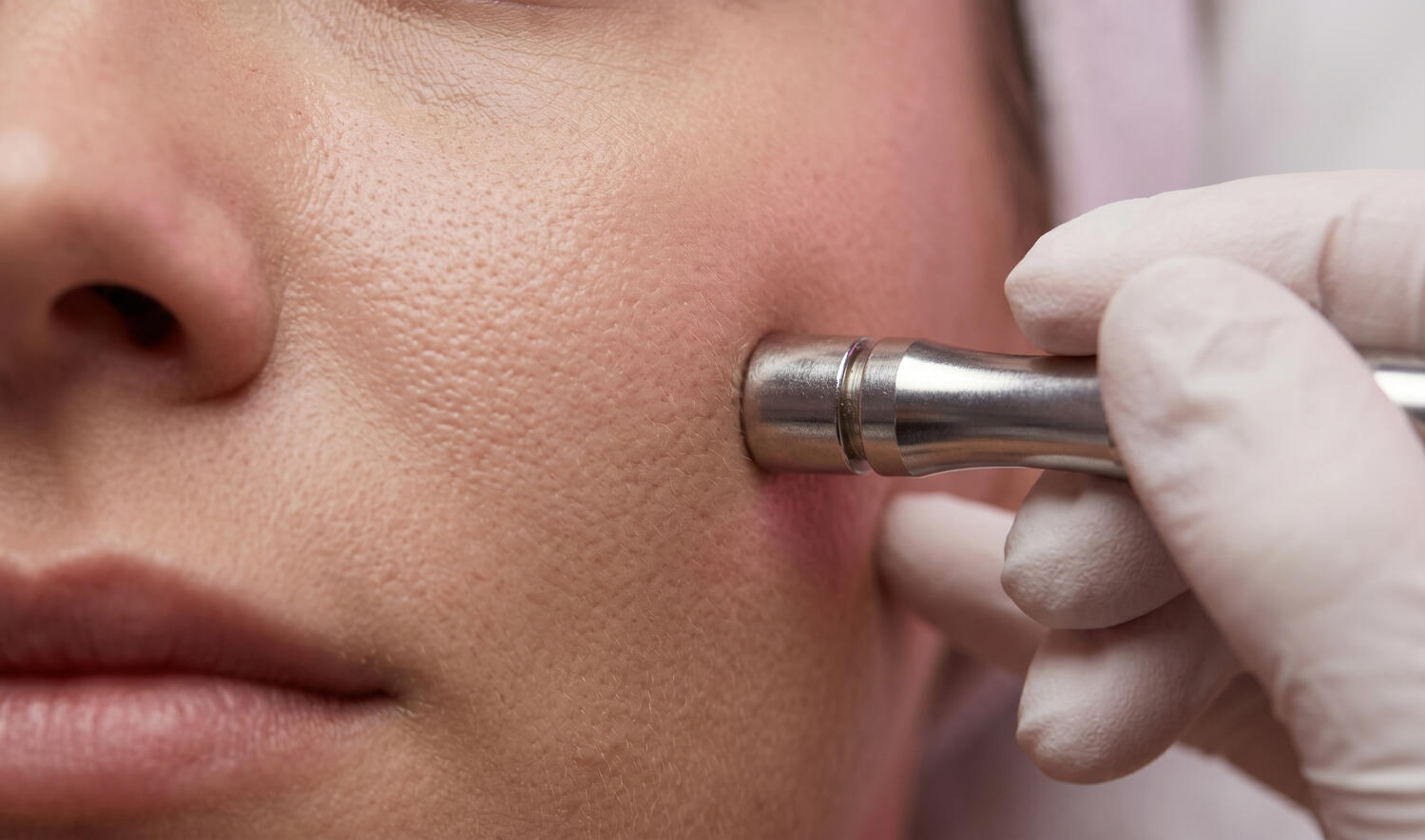 Renovación Facial Tratamiento de punta de diamante para limpieza facial profunda.